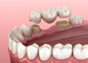Illustrated dental bridge being placed