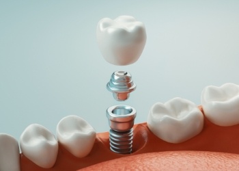Illustrated dental implant being placed in the lower jaw