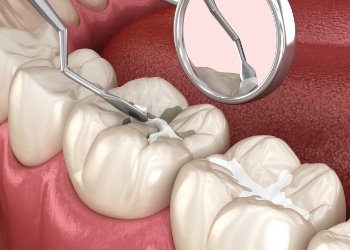Illustrated white filling being placed in a tooth