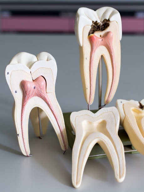 Models of decayed tooth that need root canal treatment