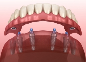 Illustrated full denture being fitted onto six dental implants on lower arch