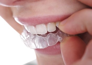 CLose up of a person placing an Invisalign aligner over their teeth