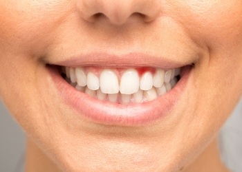 Close up of smile with red spot in the gums