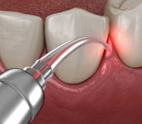 Illustrated dental laser treating gums