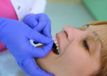 Dentist placing a veneer on a tooth