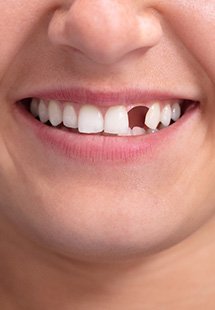 Your dentist has solutions for missing teeth in Westbrook, ME